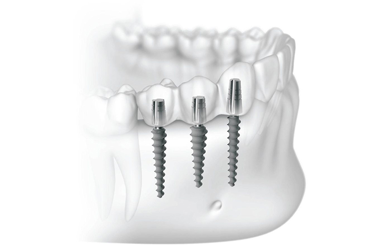 Базальная имплантация зубов: показания к установке.
