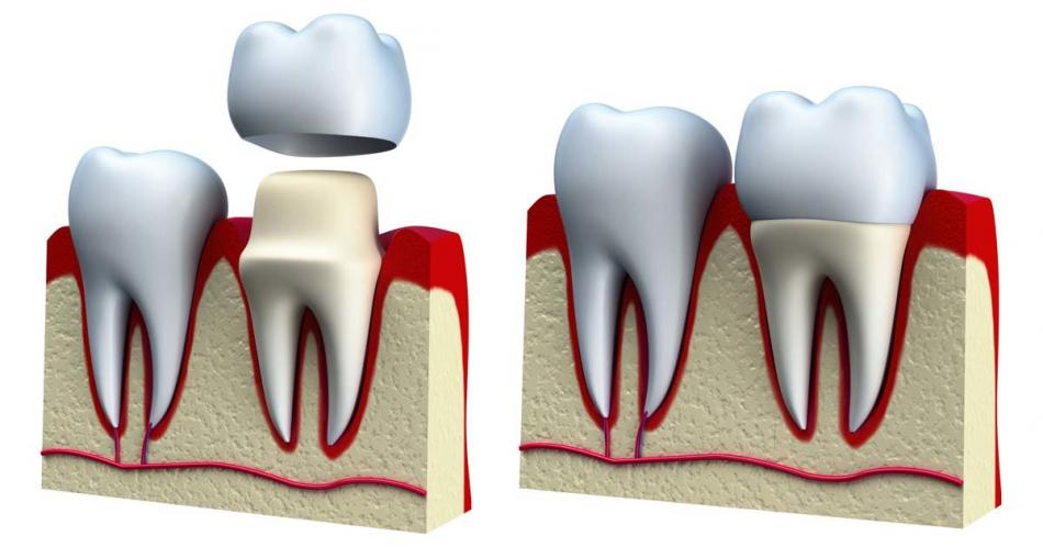 Цена несъемного протезирования в стоматологии.