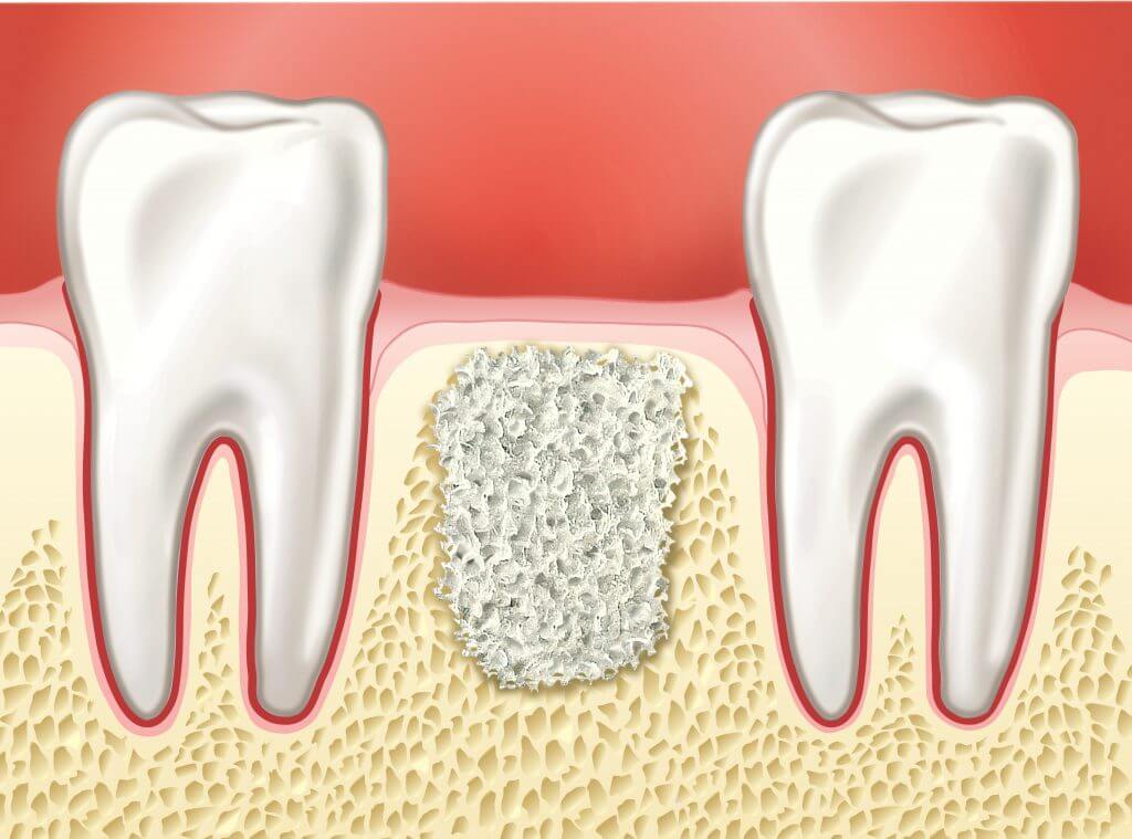 Как проводят костную пластику в стоматологии.