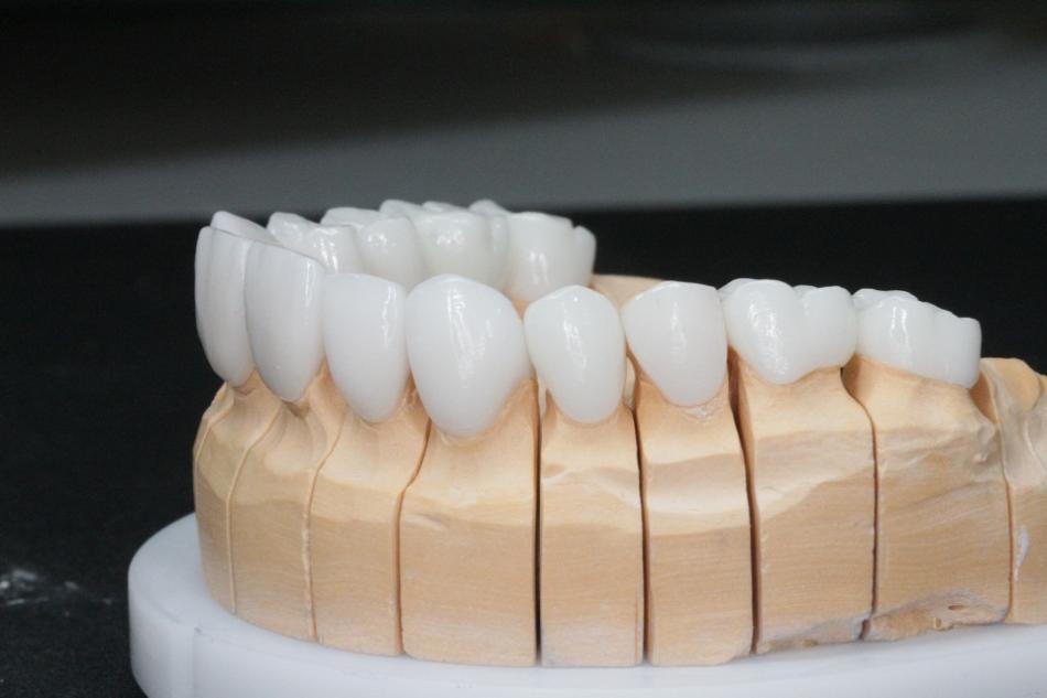 Безметалловое протезирование зубов: преимущества.