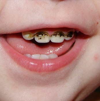 Недостатки серебрения зубов у детей.