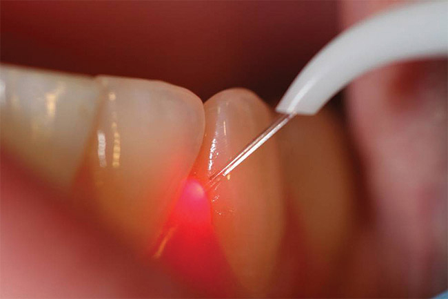 Как делают лазерное удаление кисты зуба?