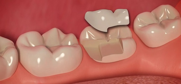 Микропротезирование: быстрое восстановление зубов.