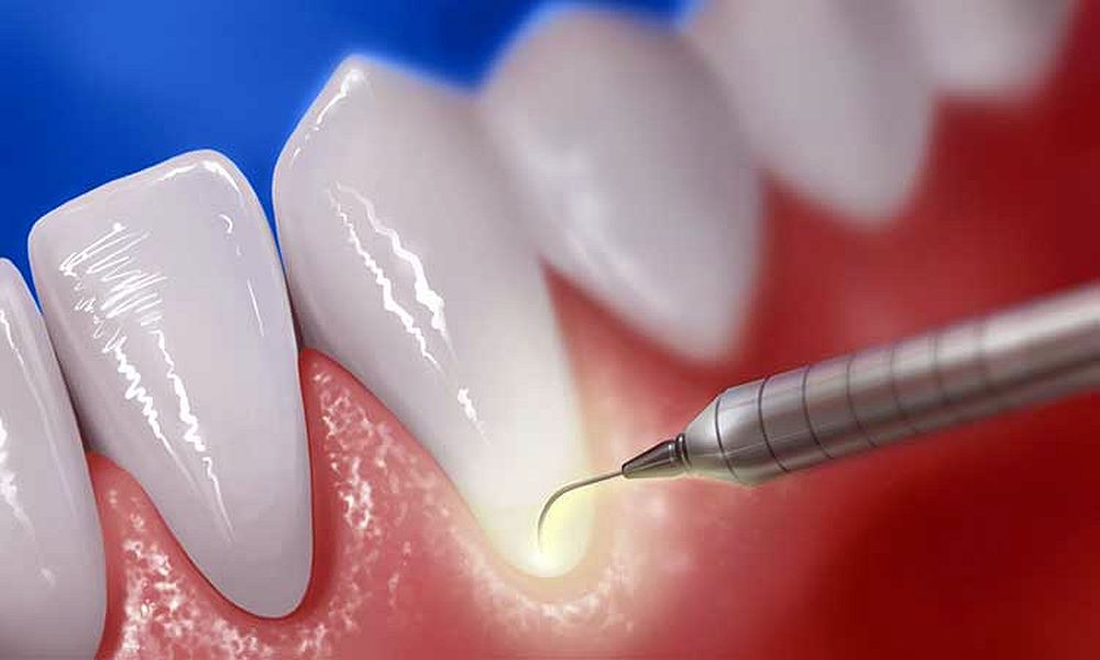 Цена гингивэктомии в стоматологии.