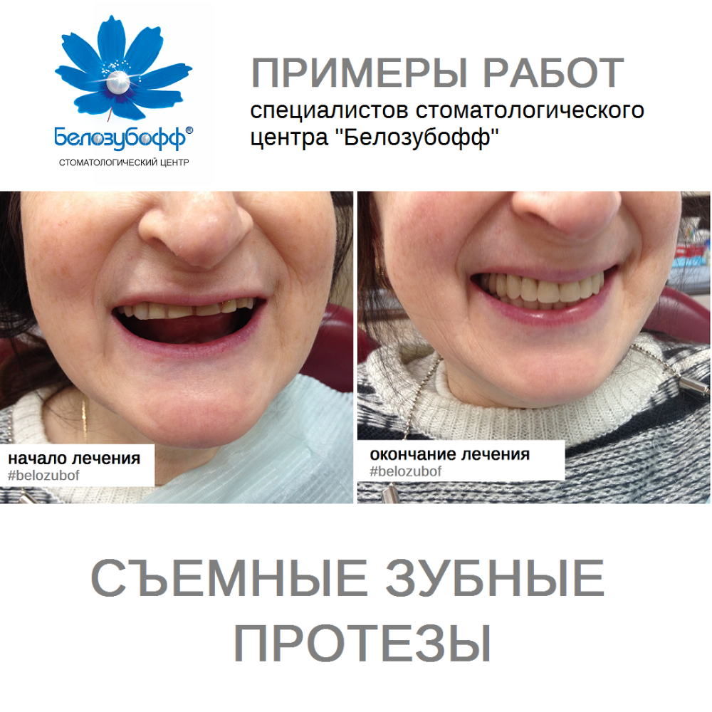 Протезы На Передние Верхние Зубы Фото