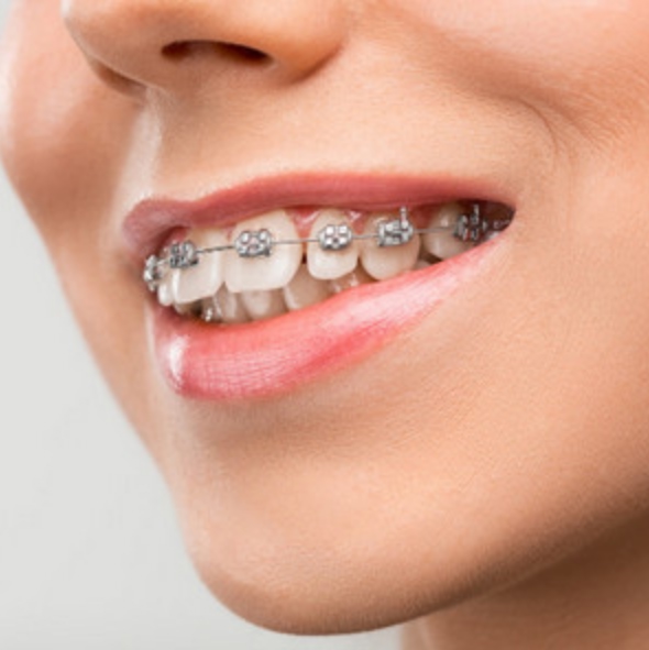 Брекет – система MINI MASTER на одну челюсть: 39 000 руб. вместо 52 000 руб.