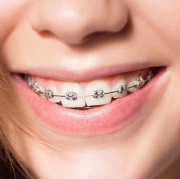 Специальное предложение на брекет-систему Damon Q
75 200 руб. вместо 94 000 руб.