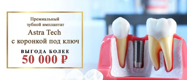 Astra Tech + коронка из циркония технология Prettau (CAD/CAM) — за 99 900 руб вместо 175060 руб