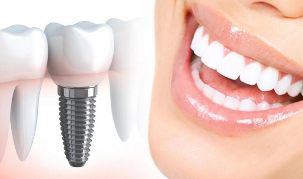 
на имплантацию и протезирование в Smile Dental Clinic