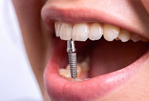 Имплант (Dentium) + коронка (металлокерамика) = 49 000 руб. (вместо 63 000 руб.). 
