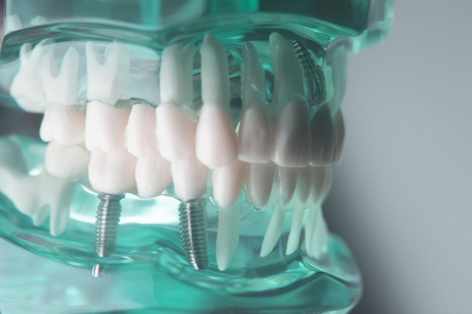 Технологии зубных имплантатов Bego Semados