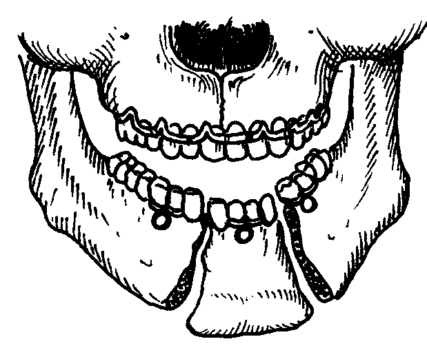 Шинирование нижней и верхней челюсти