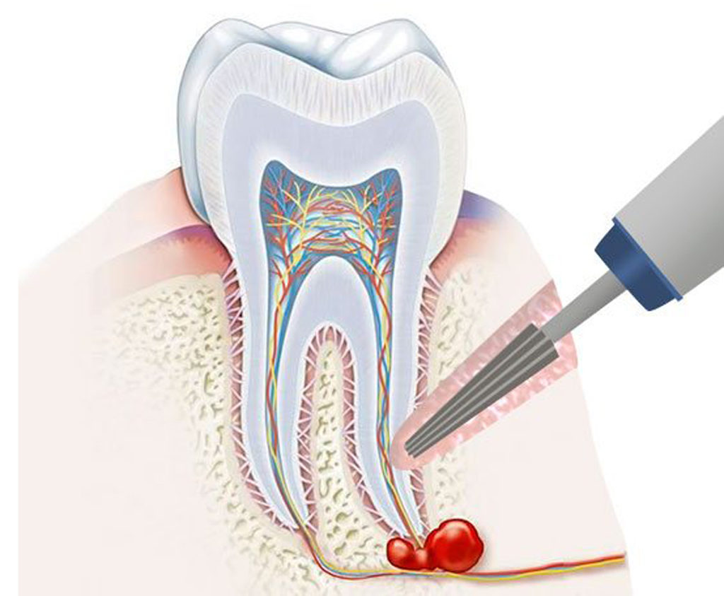 Этапы операции резекции корня зуба.