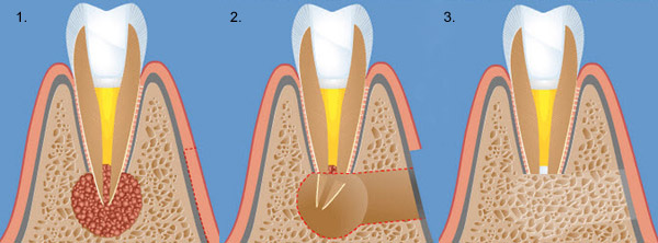 Показания к резекции корня зуба.