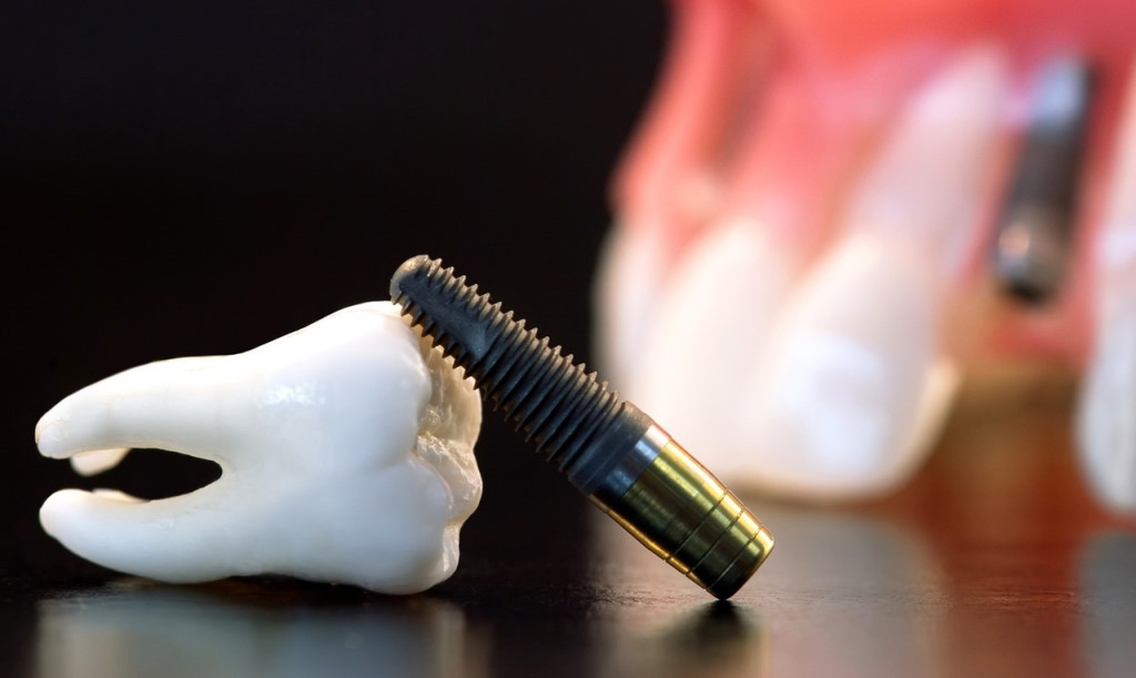 Стоимость одноэтапной имплантации зубов.