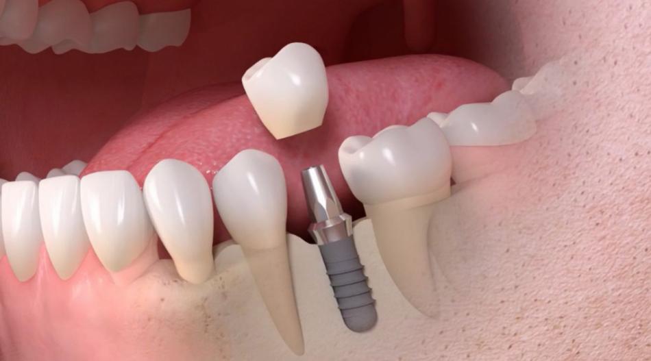 Когда возможна одномоментная имплантация зубов?
