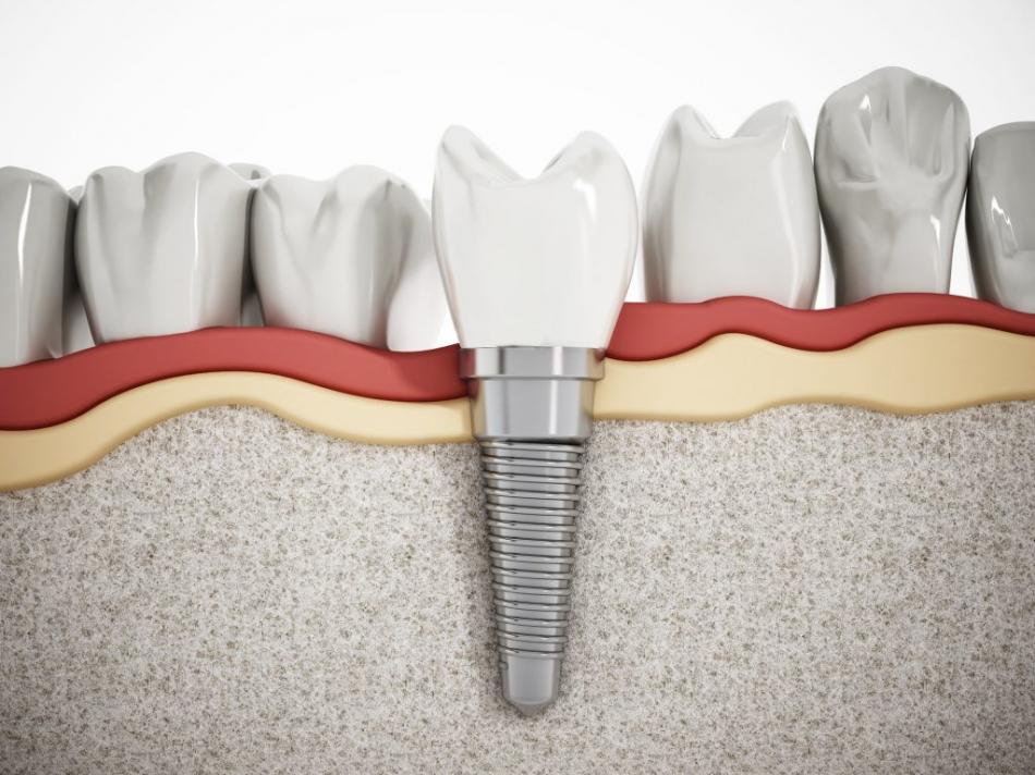 Виды зубных имплантов от разных производителей.