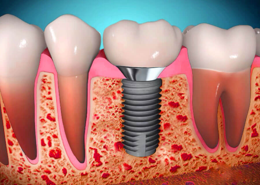 Какие есть производители зубных имплантов?