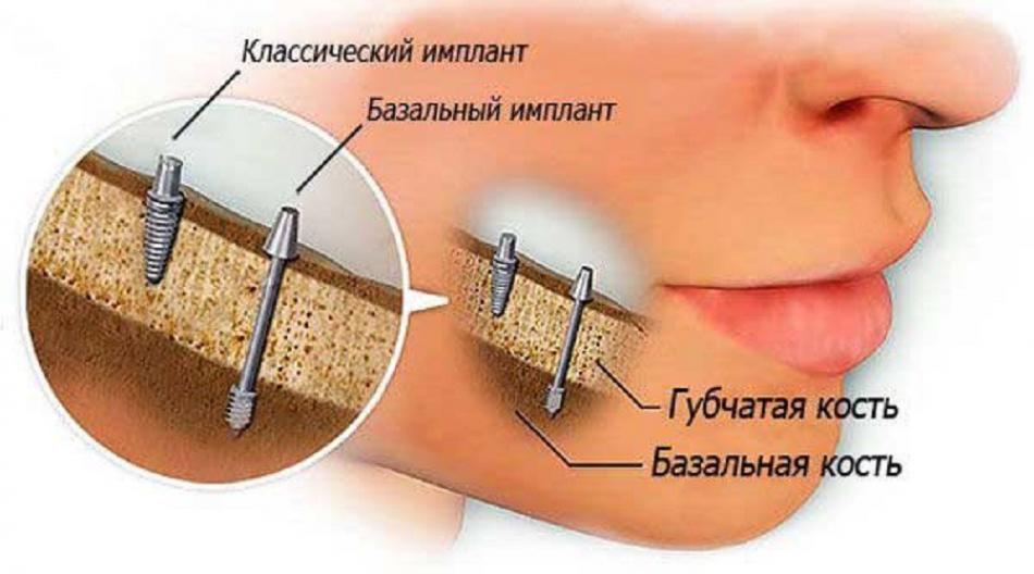 Отличие базальной имплантации от других методов.