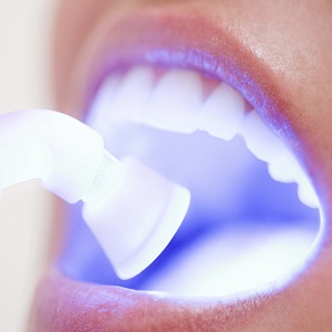 Этапы проведения лазерного отбеливания зубной эмали.