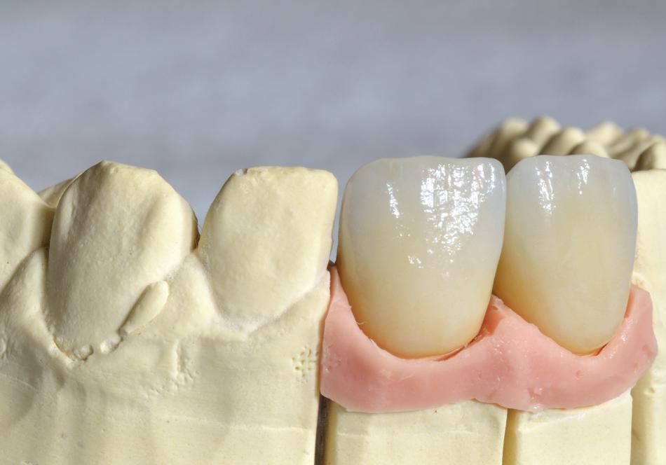 Как изготавливают металлокерамические коронки на зубы?