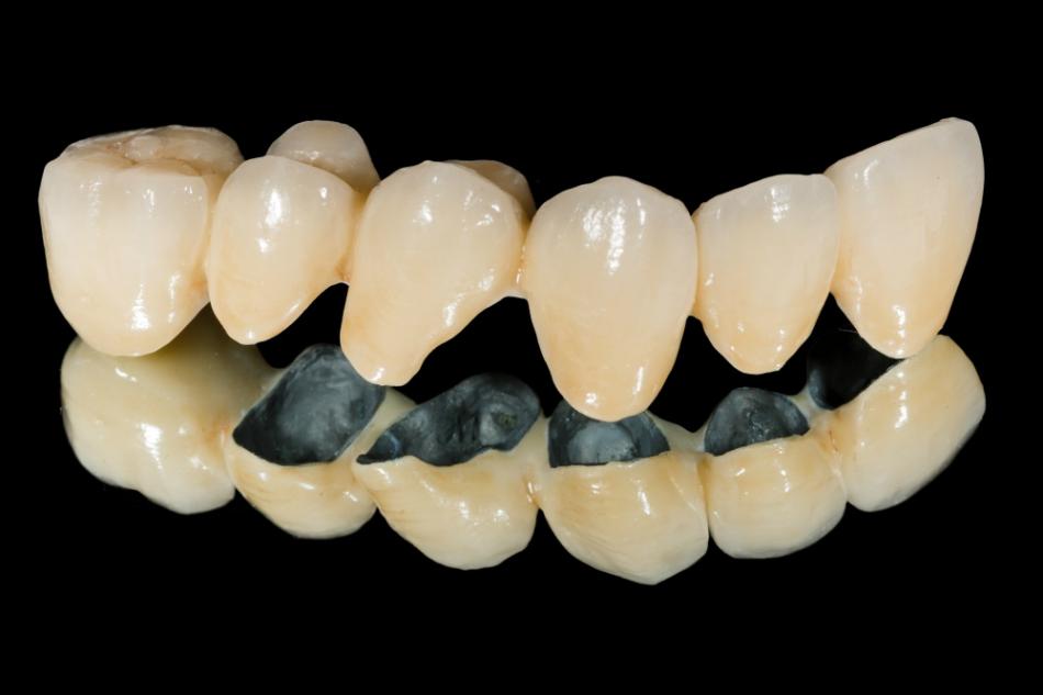 Металлокерамика на зубы: показания к установке.