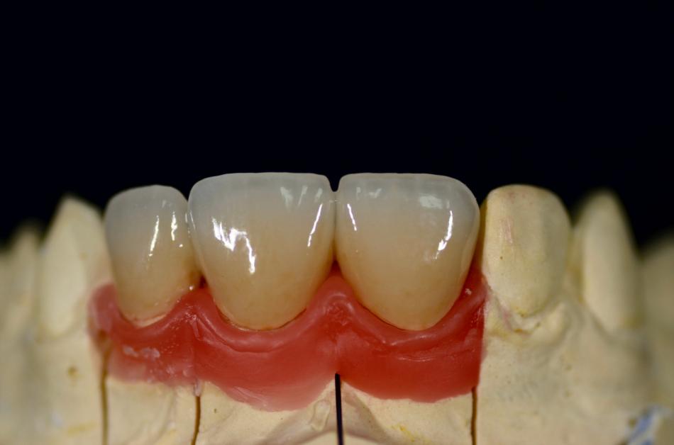 Как устанавливают металлокерамические коронки на зубы?