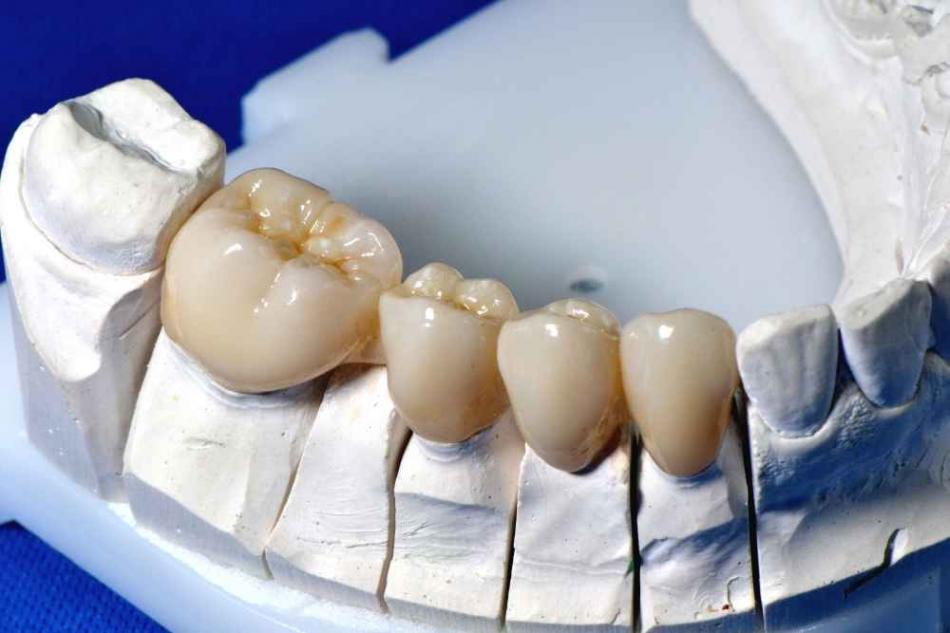 Достоинства зубной металлокерамической коронки.