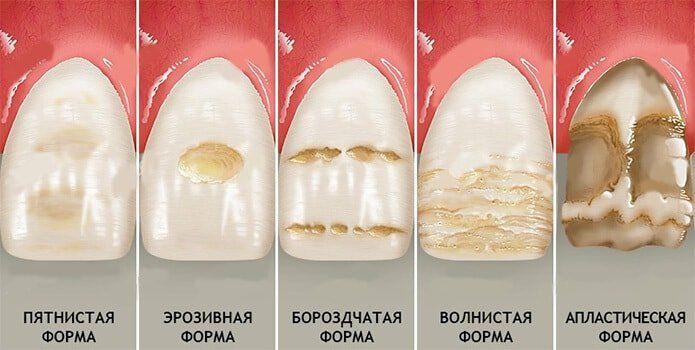 Гипоплазия эмали: причины и формы заболевания.