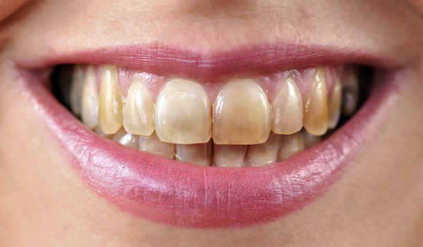 Как избавиться от темных пятен на зубах?