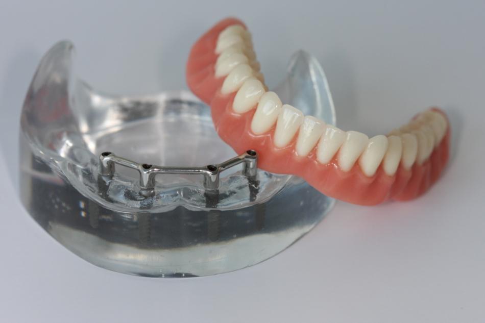 Полное протезирование при отсутствии зубов.
