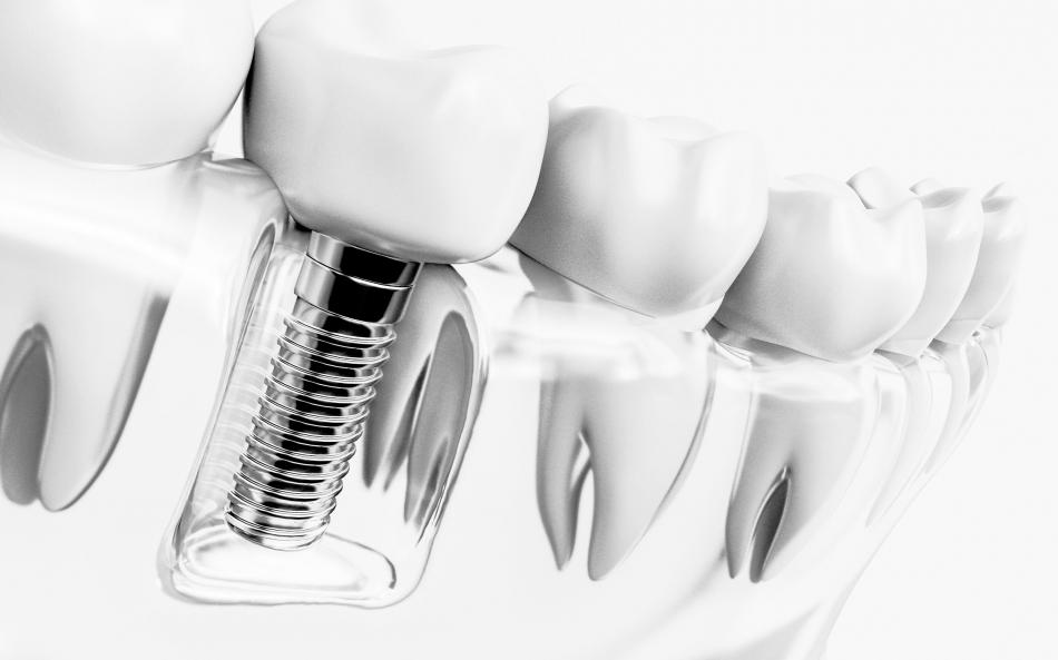 Импланты зубов - какой выбрать?