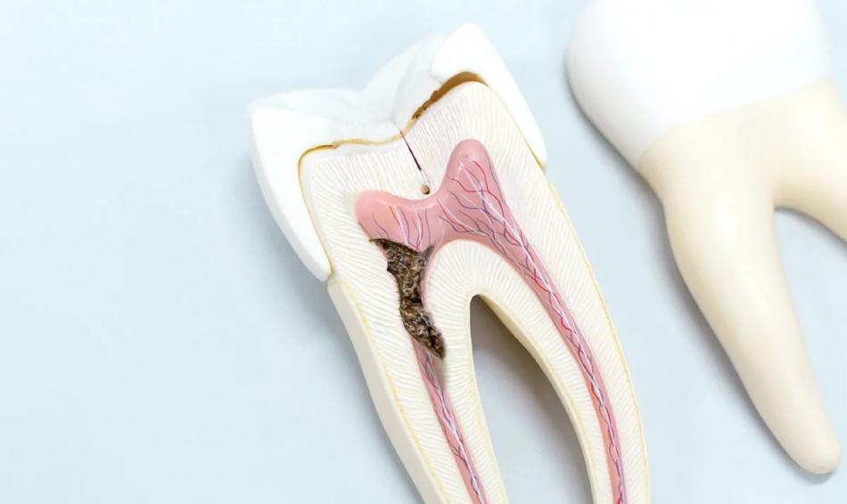 Почему образуется кариес на зубах?