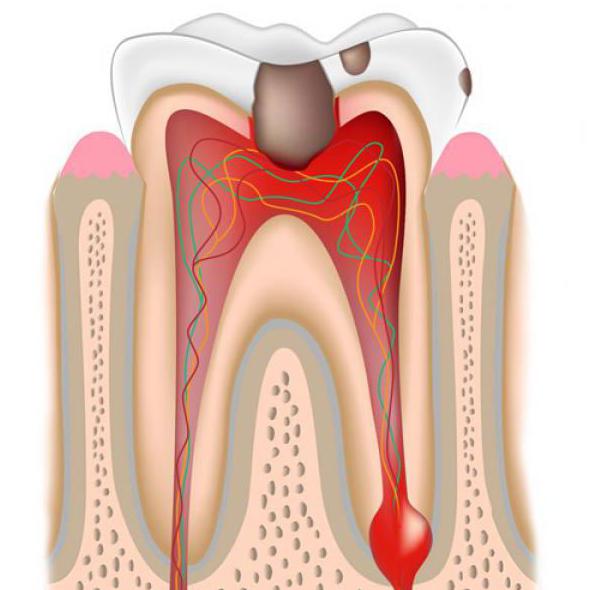 Пульпит зуба: симптомы и способы лечения.