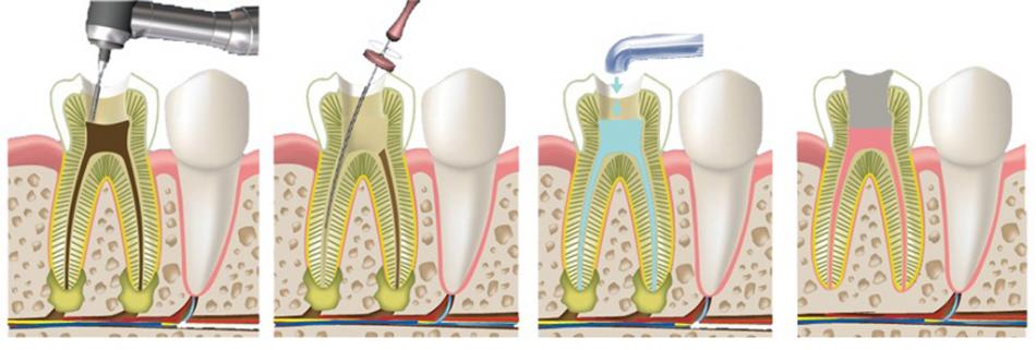 Современные методы лечения пульпита зуба.