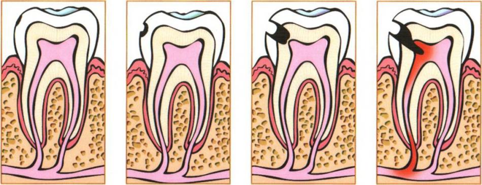 Основные методы терапии пульпита зуба.