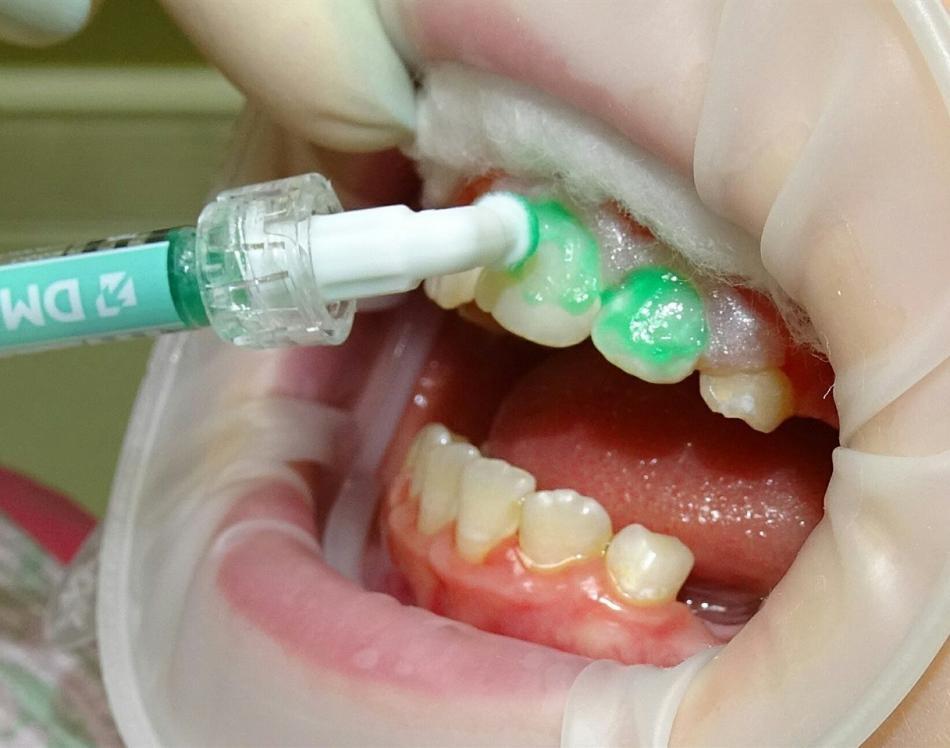 Лечение зубного кариеса системой Icon.