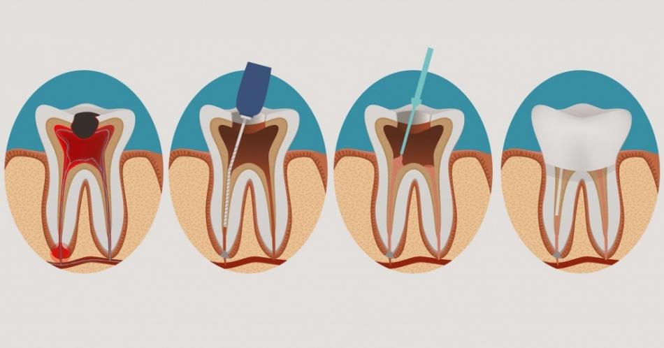 Эндодонтическое лечение корневых каналов зубов.