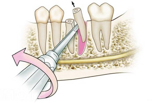 Удаление части молочного зуба или верхушки корня.