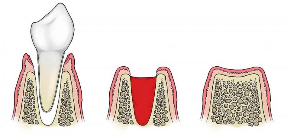 Возможные осложнения после удаления зуба.
