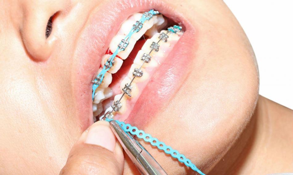 Как ставят брекеты на зубы в стомтаологии?