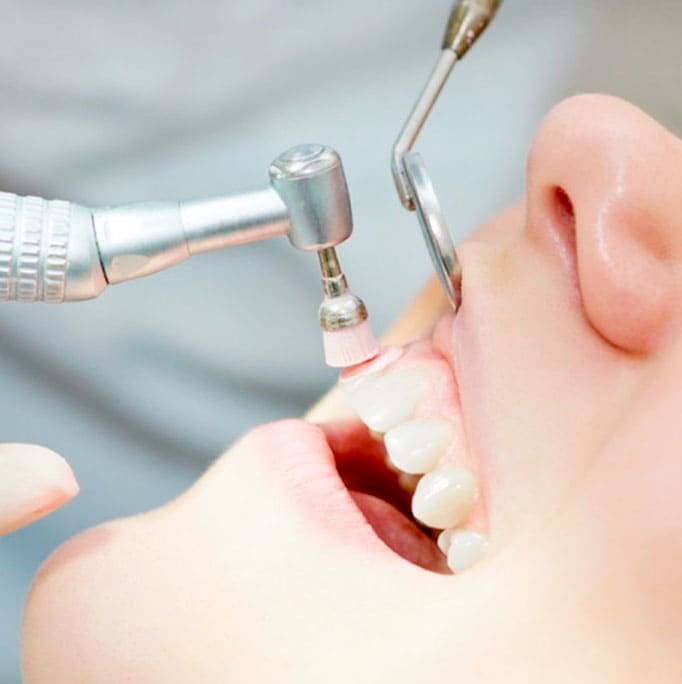 Профессиональная чистка зубов: основные методы.