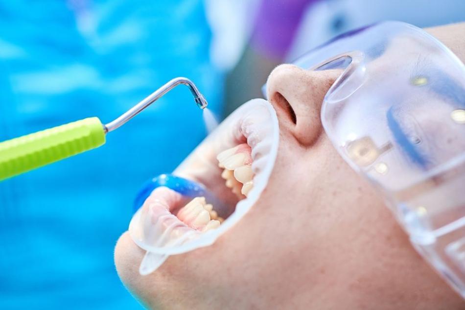 Профессиональная чистка зубов: показания к процедуре.