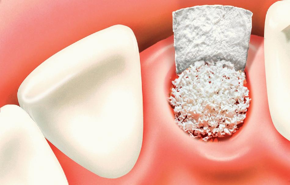 Остеопластика для имплантации зубов.