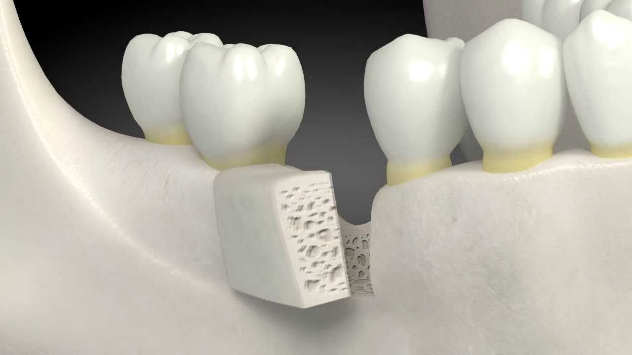 Наращивание костной ткани зуба: когда делают.