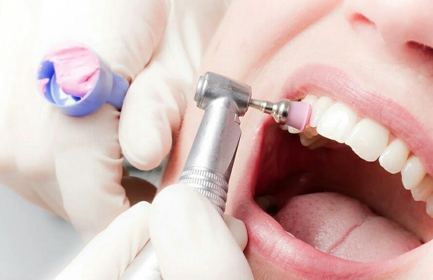 Как делают чистку и отбеливание зубов в стоматологии?