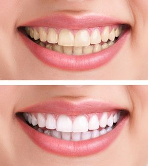 Виды отбеливания зубов в стоматологии.