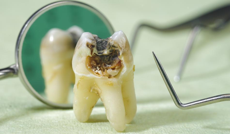 Как проходит консультация стоматолога-терапевта