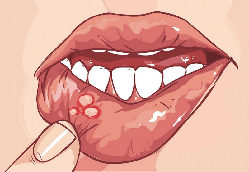 Симптомы и причины стоматита в полости рта.