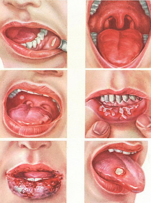 Виды стоматита во рту и методы их лечения.